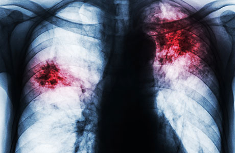 A Chronic, Rare Lung Disease Causes More Than Just Irreversible Scarring of the Lungs